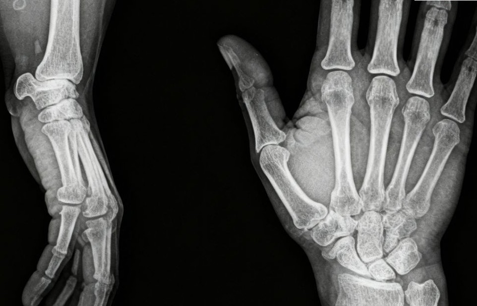 X-RAY RT WRIST AP/LAT
